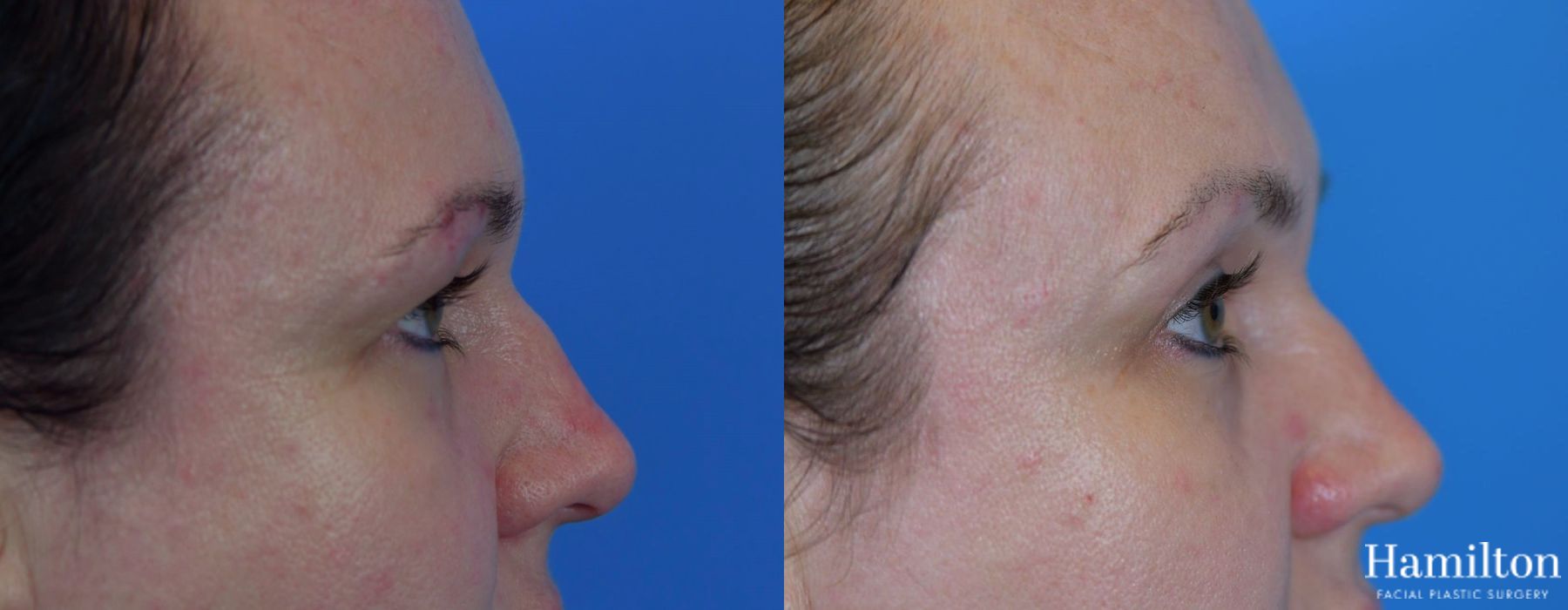 Before and after Blepharoplasty case 37304 - Angle 3
