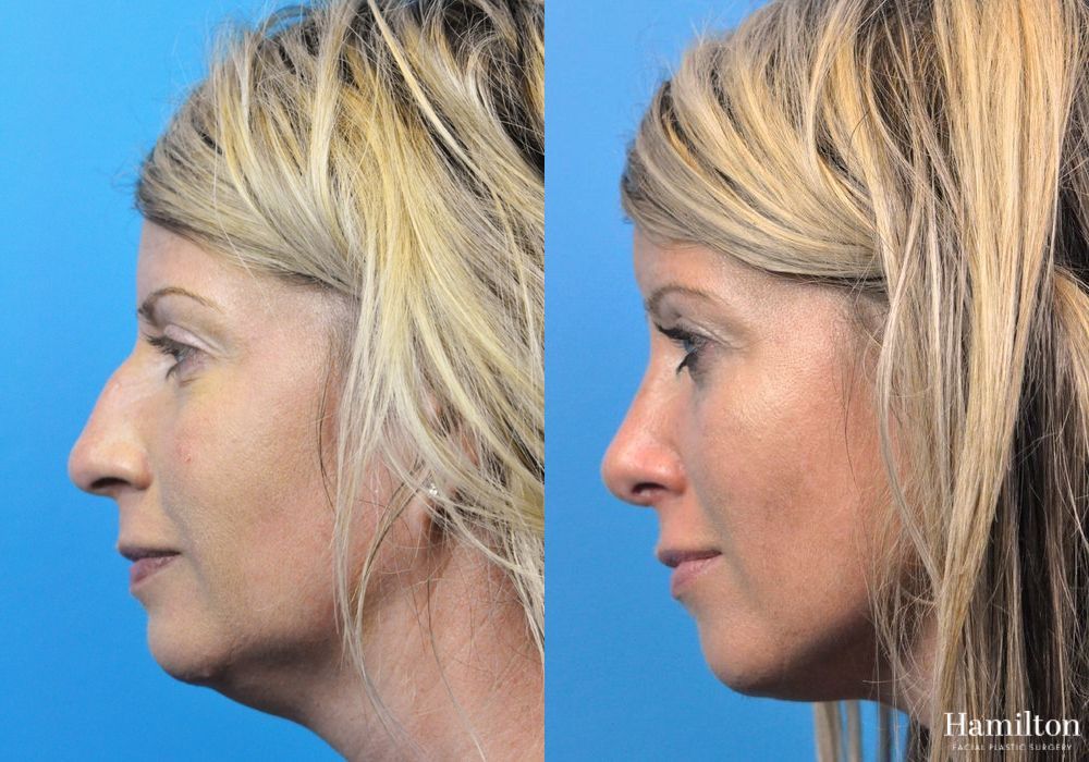 Before and after Rhinoplasty case 37334
