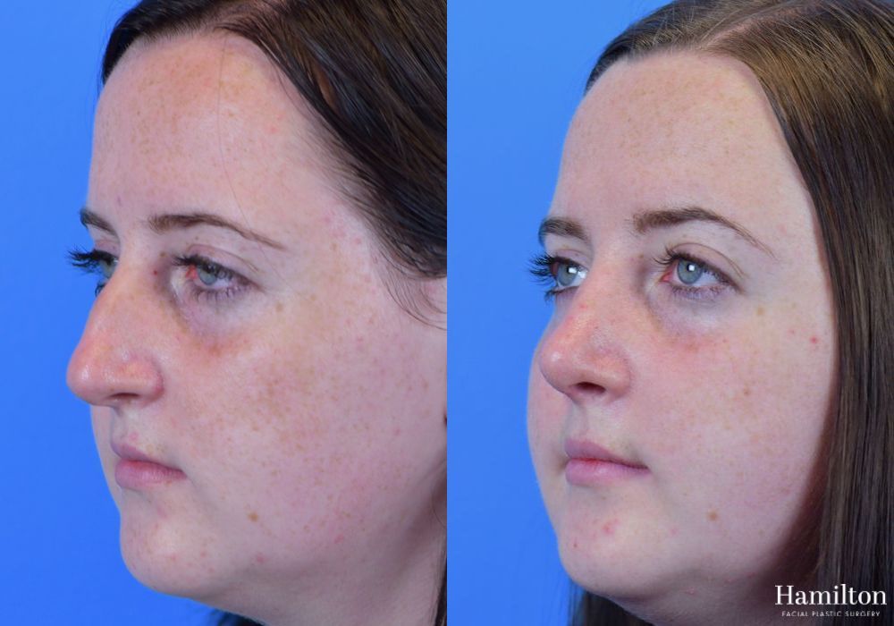 Before and after Rhinoplasty case 37339 - Angle 4