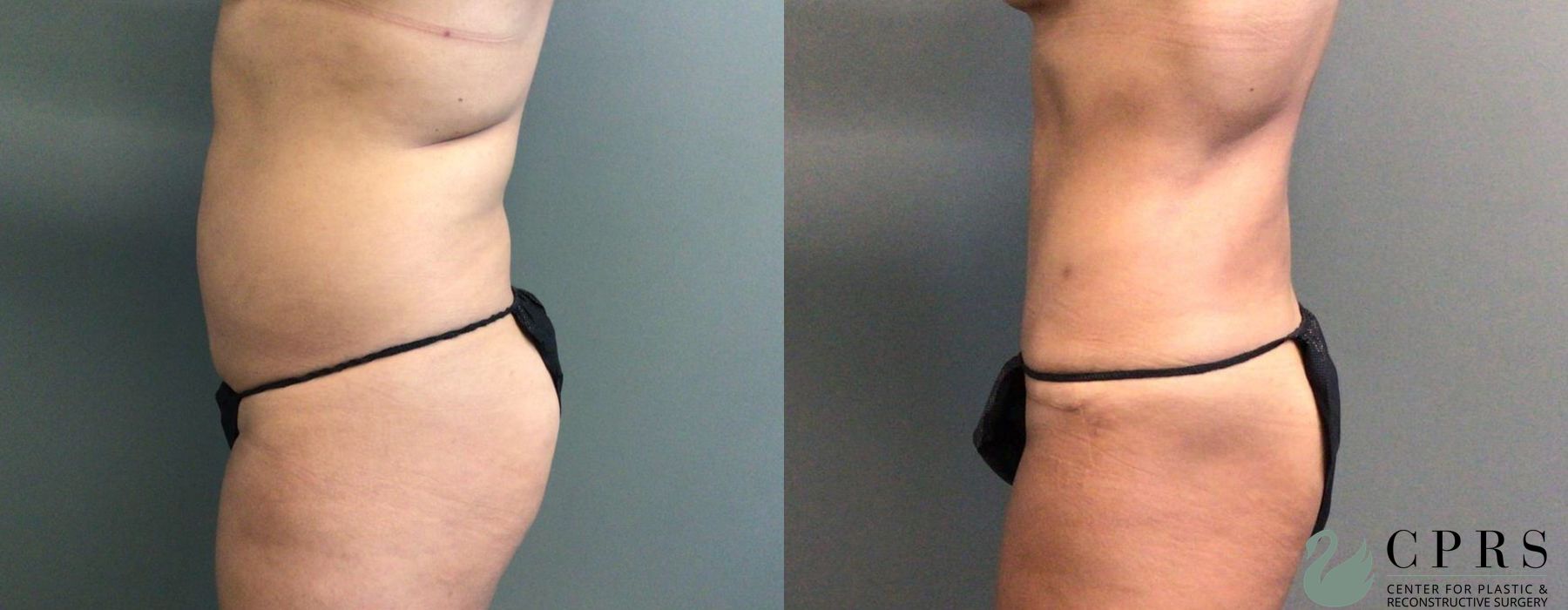 Before and after Abdominoplasty case 19151 - Angle 3