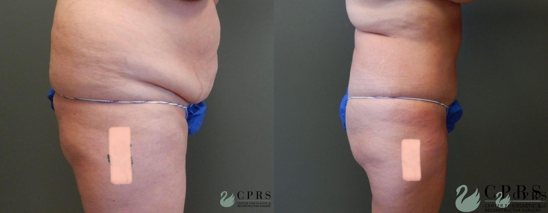 Before and after Abdominoplasty case 19007 - Angle 2