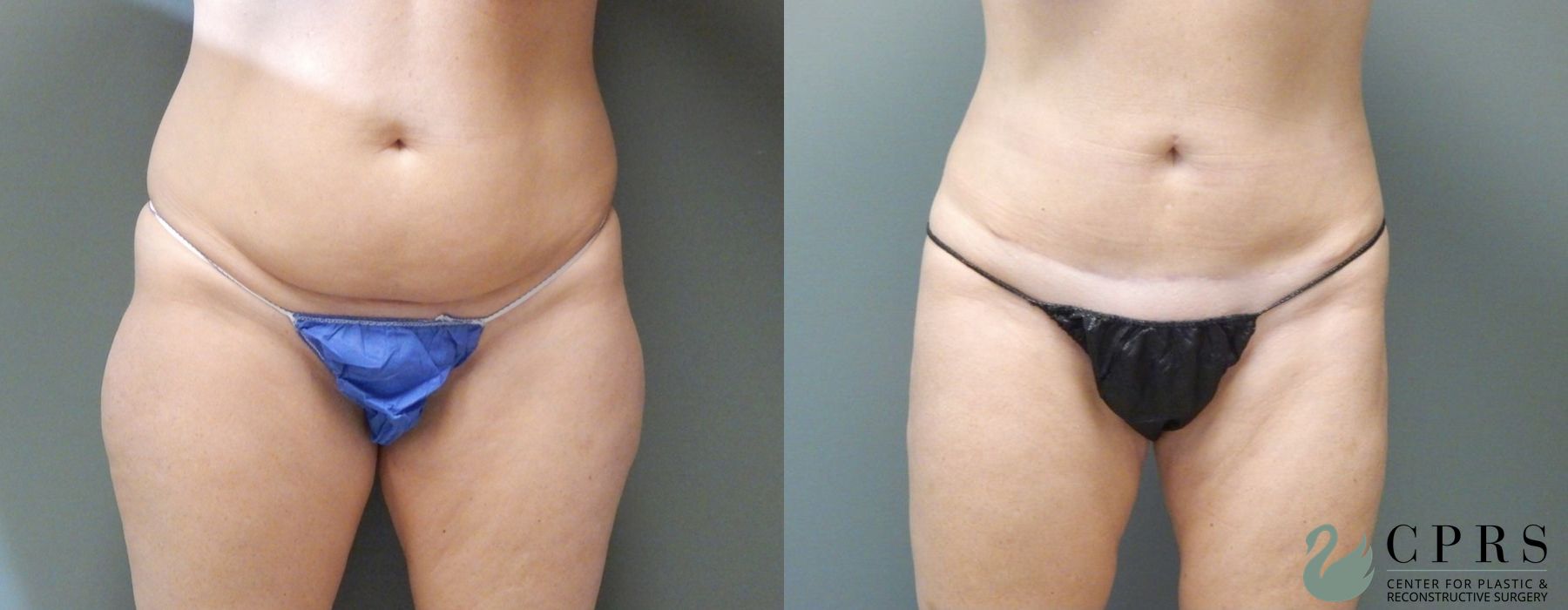 Before and after Abdominoplasty case 19014