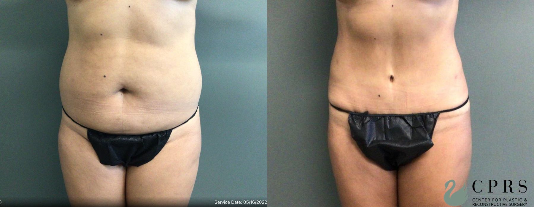 Before and after Abdominoplasty case 19151