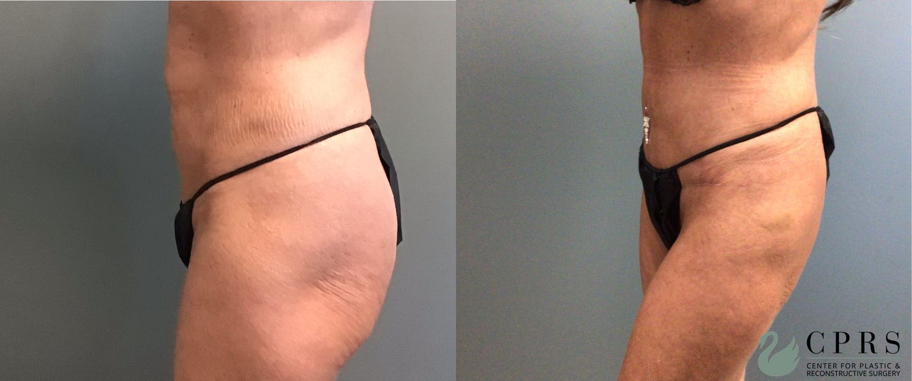 Before and after Abdominoplasty case 49394 - Angle 2