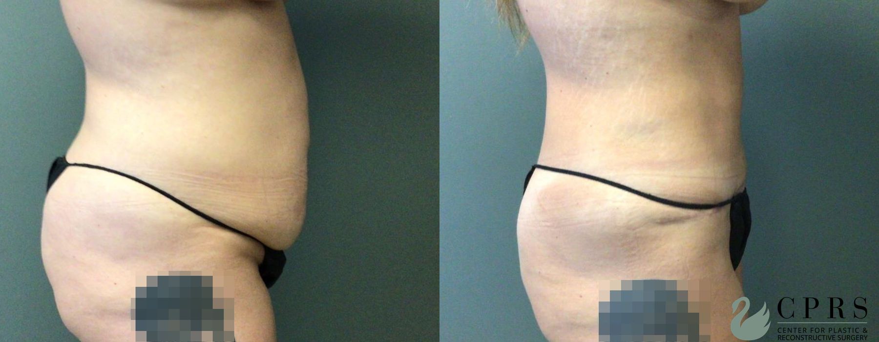 Before and after Abdominoplasty case 19201 - Angle 3