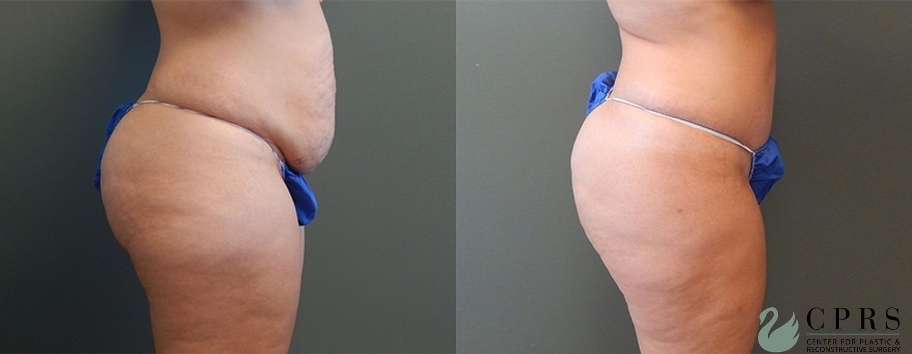 Before and after Abdominoplasty case 18924 - Angle 2