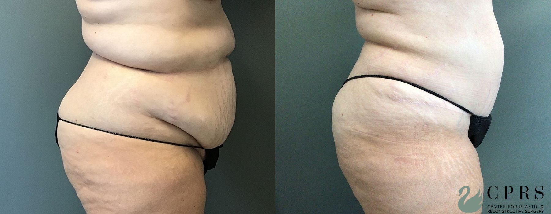 Abdominoplasty - Thumbnail 2