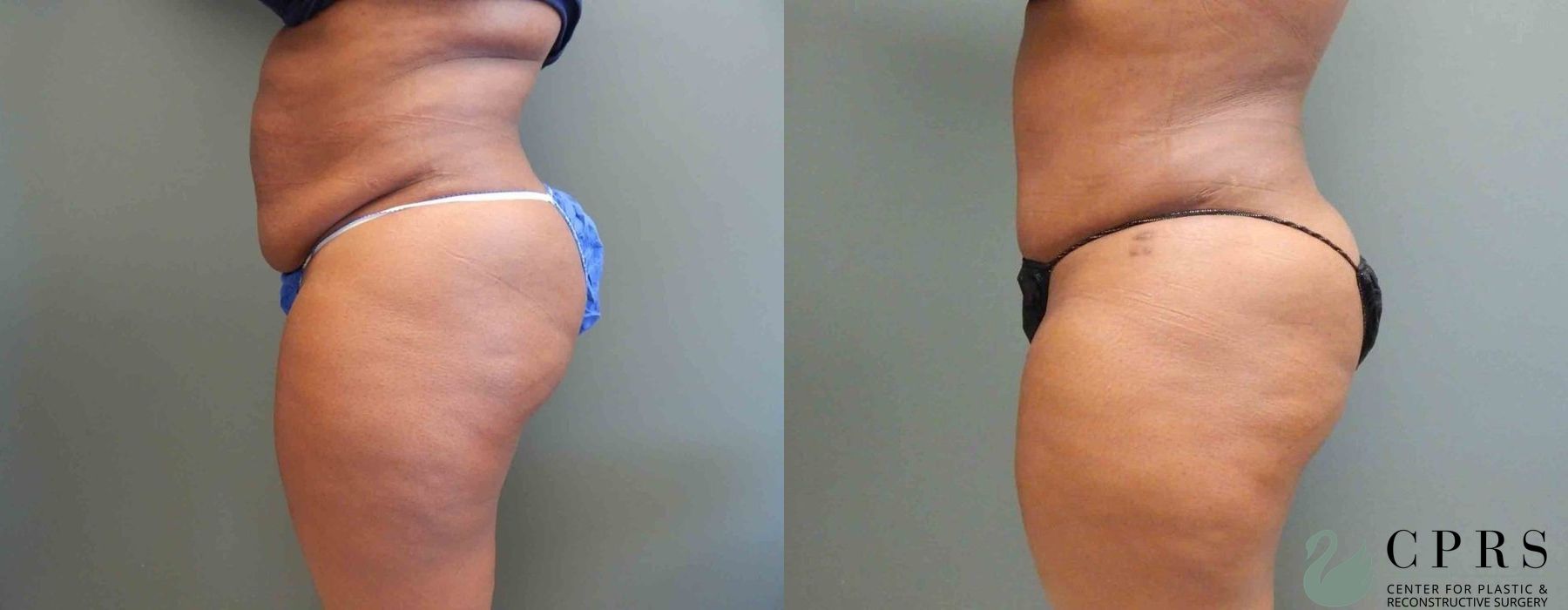 Abdominoplasty - Thumbnail 4