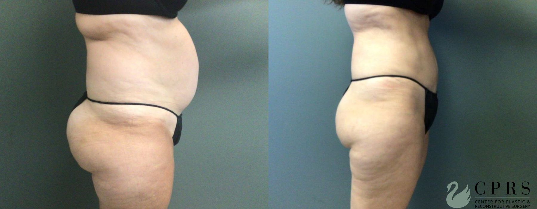 Before and after Abdominoplasty case 19032 - Angle 3