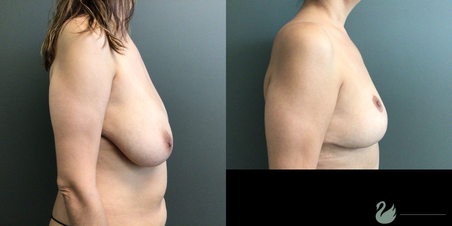 Before and after Abdominoplasty case 43546 - Angle 6