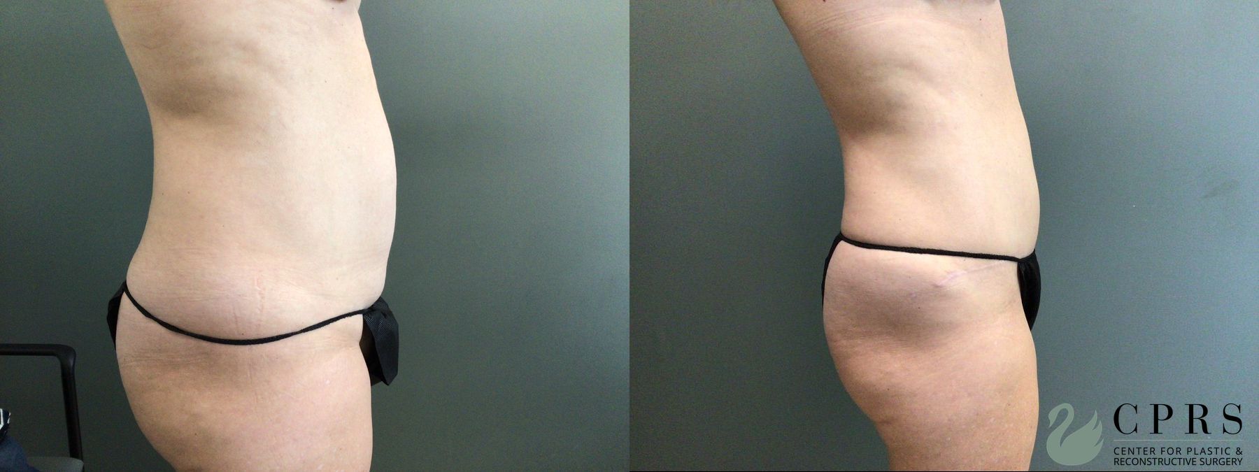 Before and after Abdominoplasty case 43070 - Angle 3