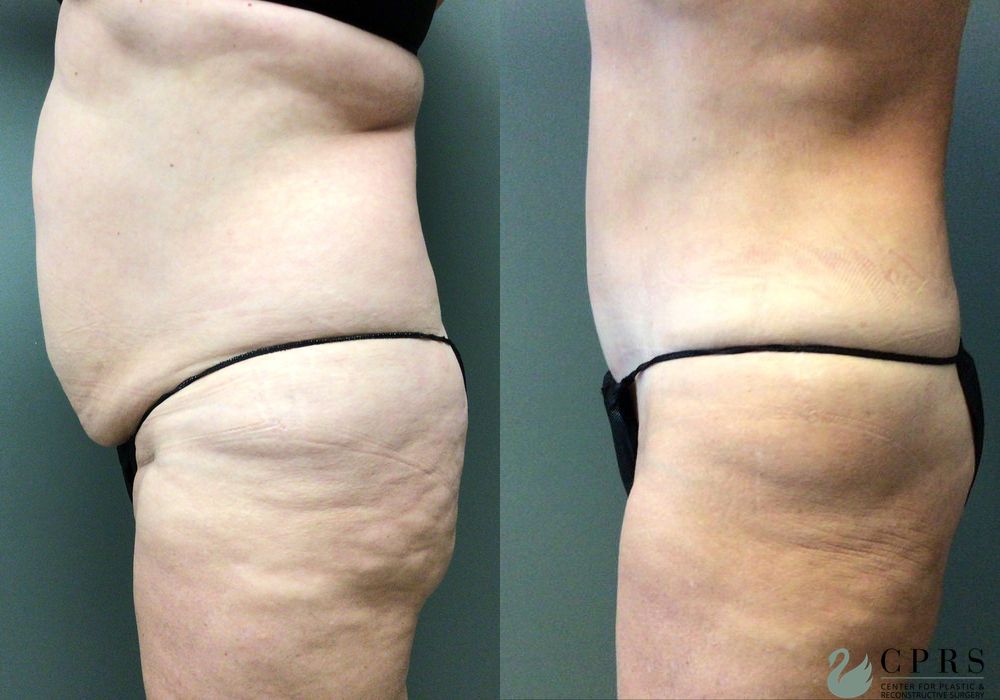 Before and after Abdominoplasty case 21553 - Angle 2