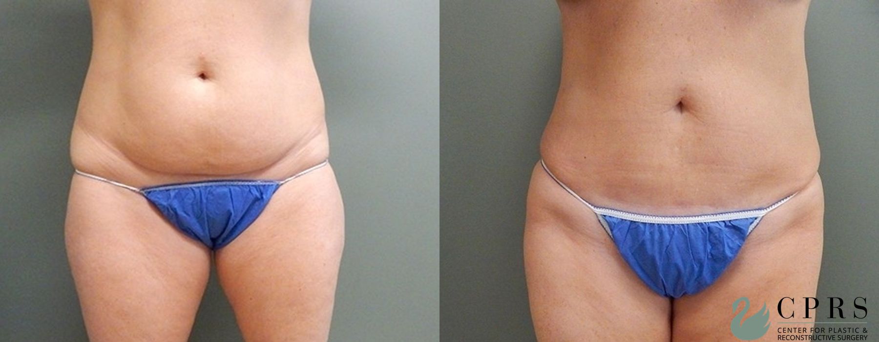 Before and after Abdominoplasty case 19009