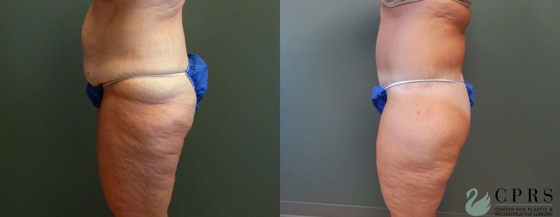 Before and after Abdominoplasty case 19000 - Angle 3