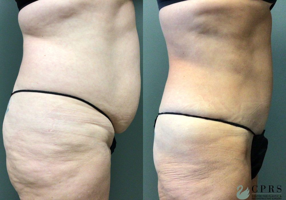 Before and after Abdominoplasty case 21553 - Angle 3