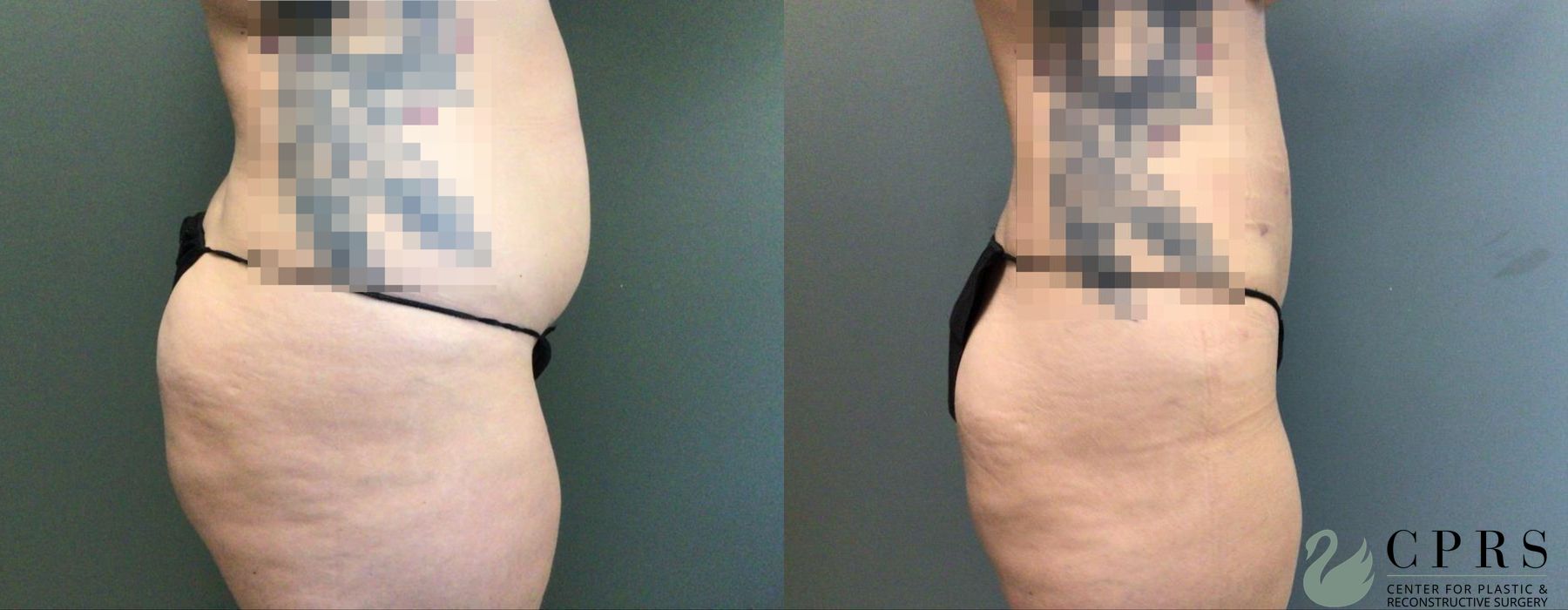 Before and after Abdominoplasty case 19170 - Angle 2