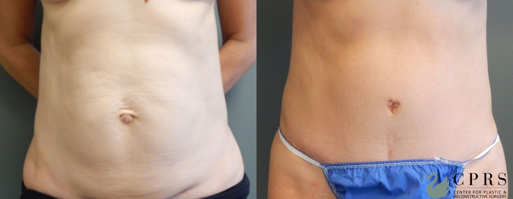 Before and after Abdominoplasty case 19006