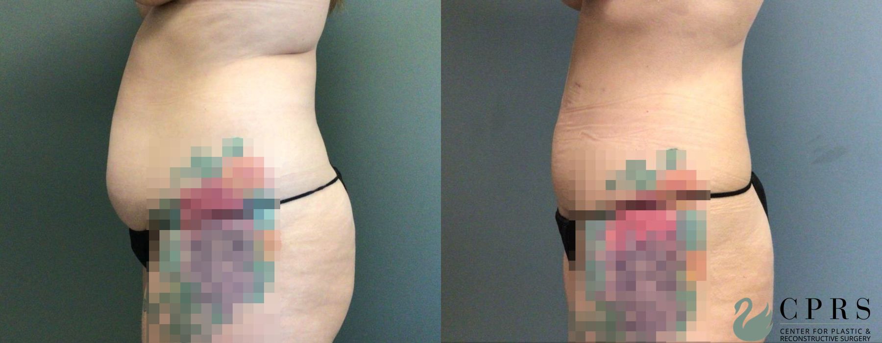 Before and after Abdominoplasty case 19170 - Angle 3