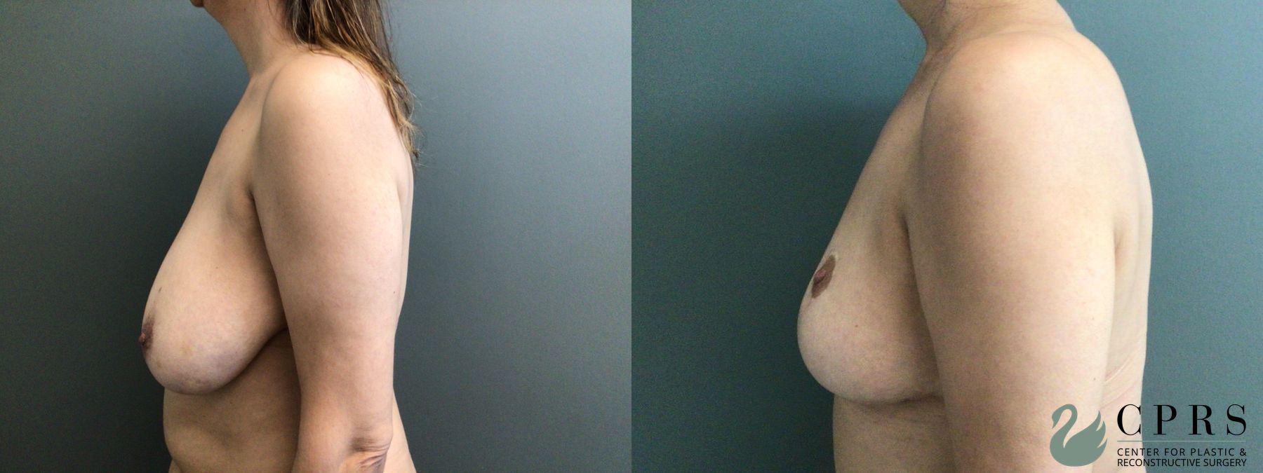 Before and after Abdominoplasty case 43546 - Angle 5
