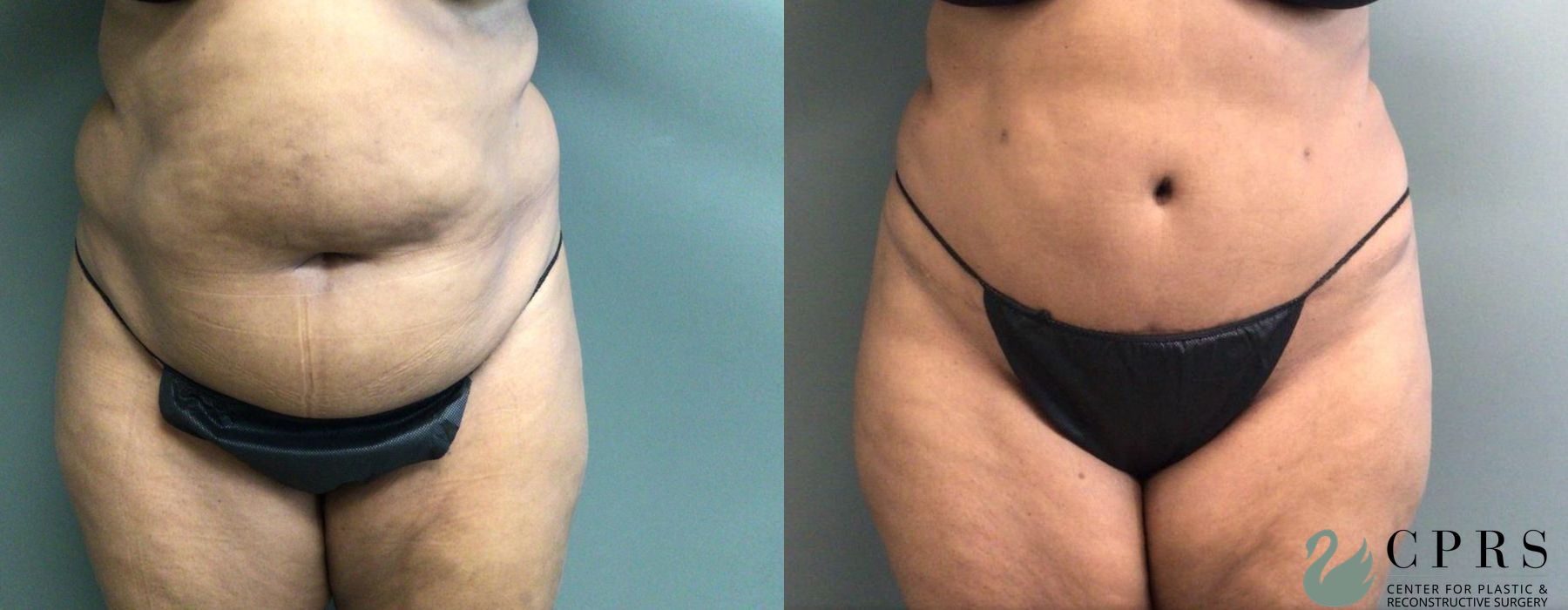 Before and after Abdominoplasty case 19187
