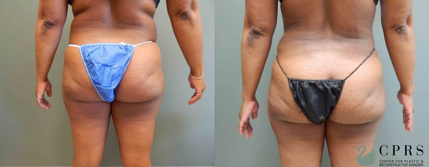 Abdominoplasty - Thumbnail 2