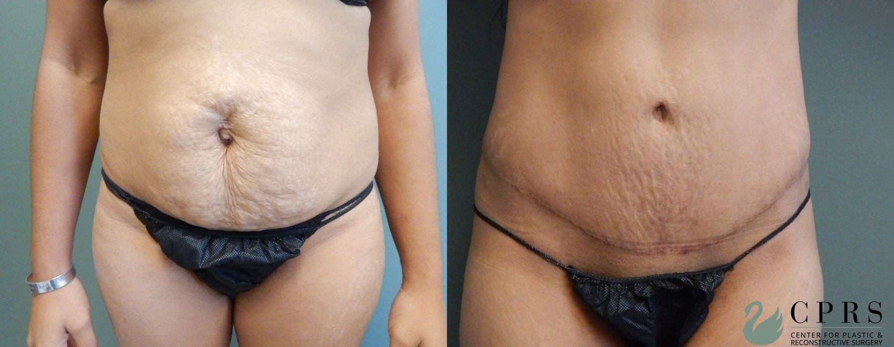 Before and after Abdominoplasty case 19013