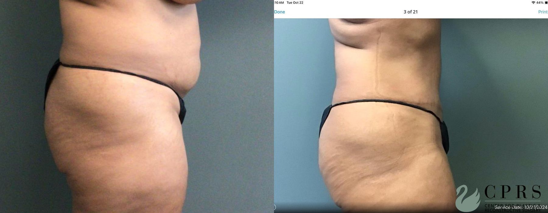 Before and after Abdominoplasty case 19194 - Angle 3