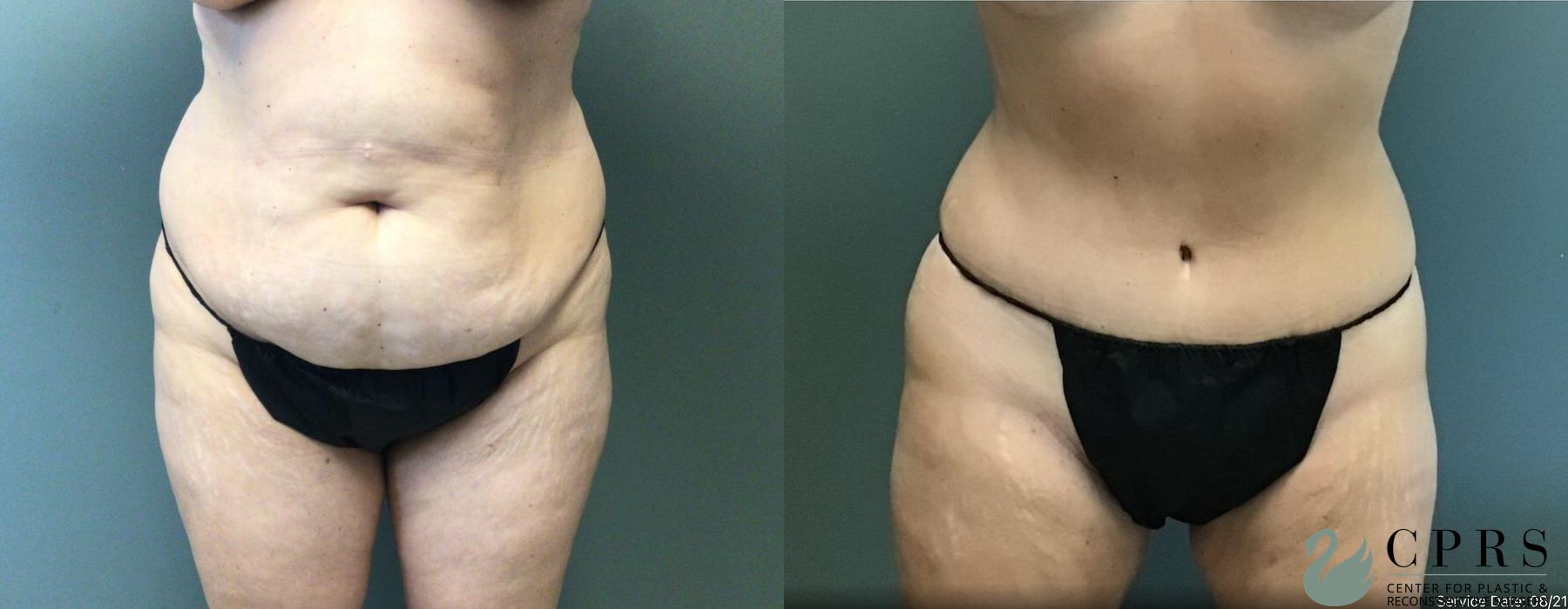 Before and after Abdominoplasty case 19149