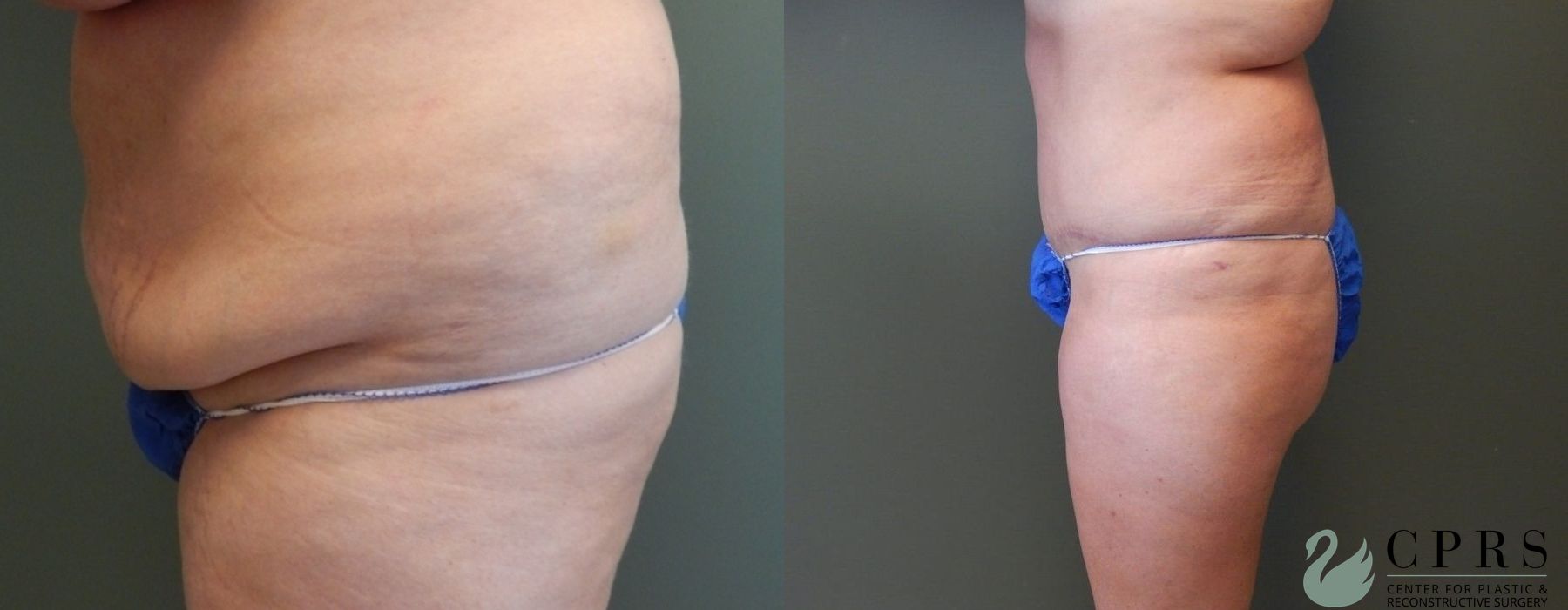 Before and after Abdominoplasty case 19007 - Angle 3
