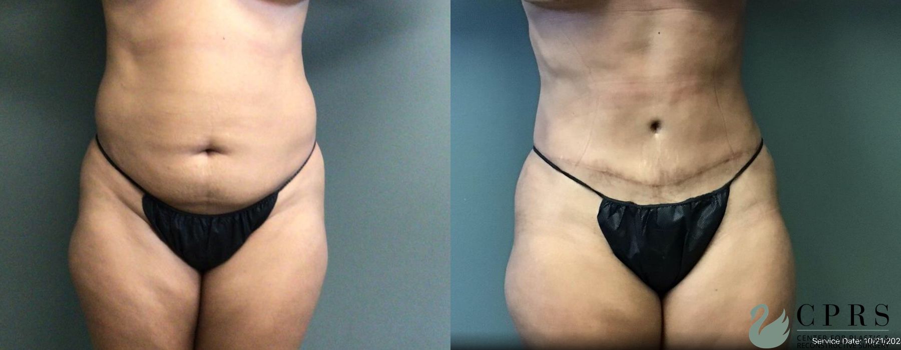 Before and after Abdominoplasty case 19194