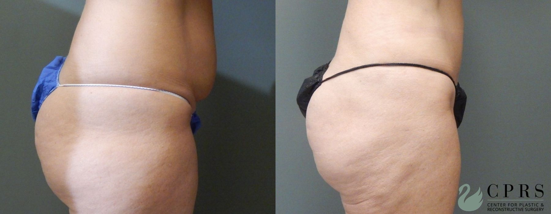Before and after Abdominoplasty case 19014 - Angle 3