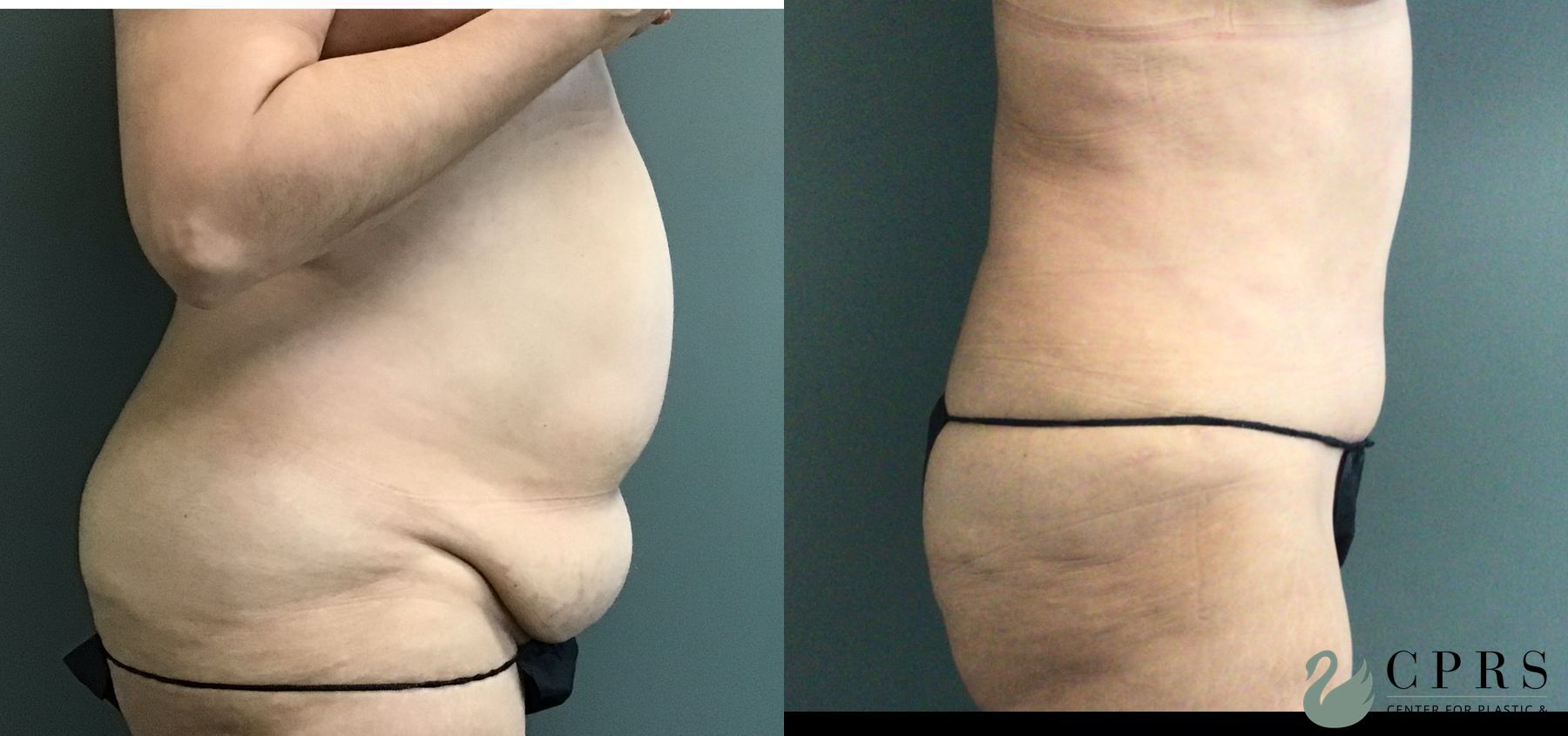 Before and after Abdominoplasty case 43546 - Angle 3