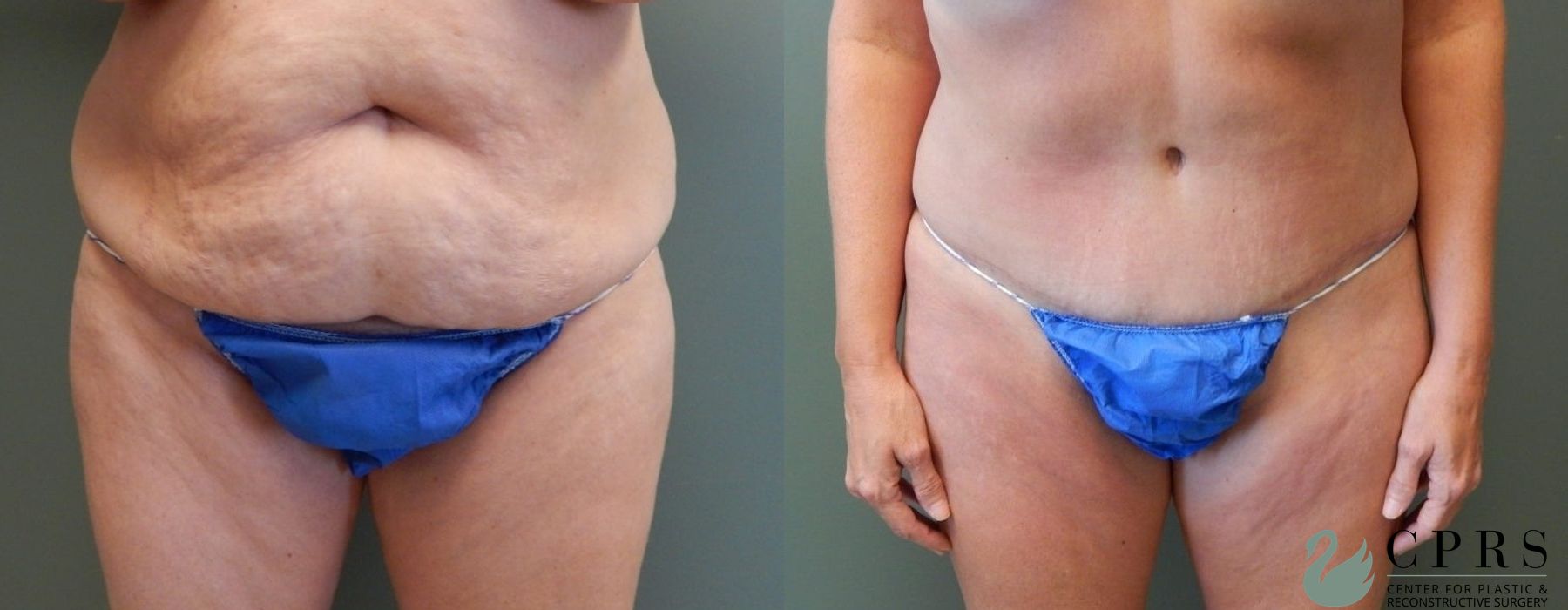 Before and after Abdominoplasty case 19007