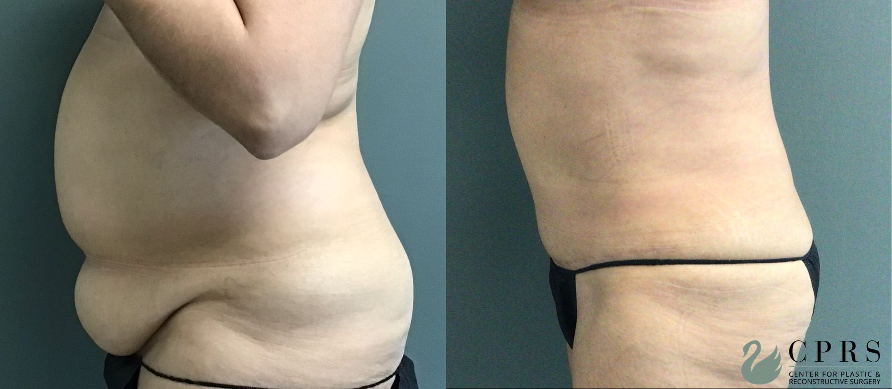Before and after Abdominoplasty case 43546 - Angle 2