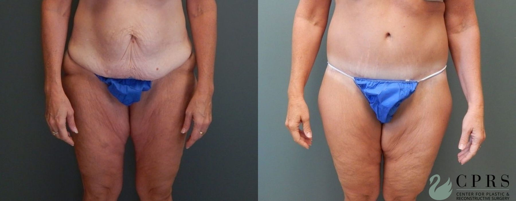 Before and after Abdominoplasty case 19000