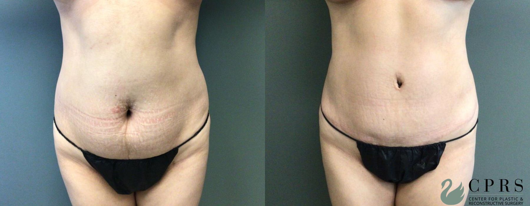 Before and after Abdominoplasty case 19176