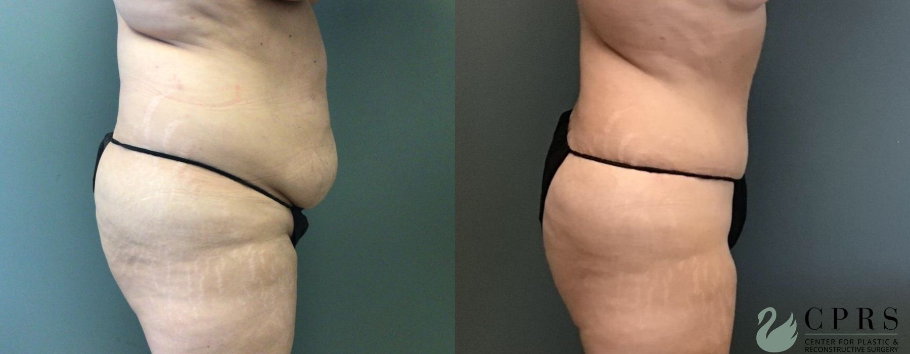 Before and after Abdominoplasty case 19149 - Angle 2