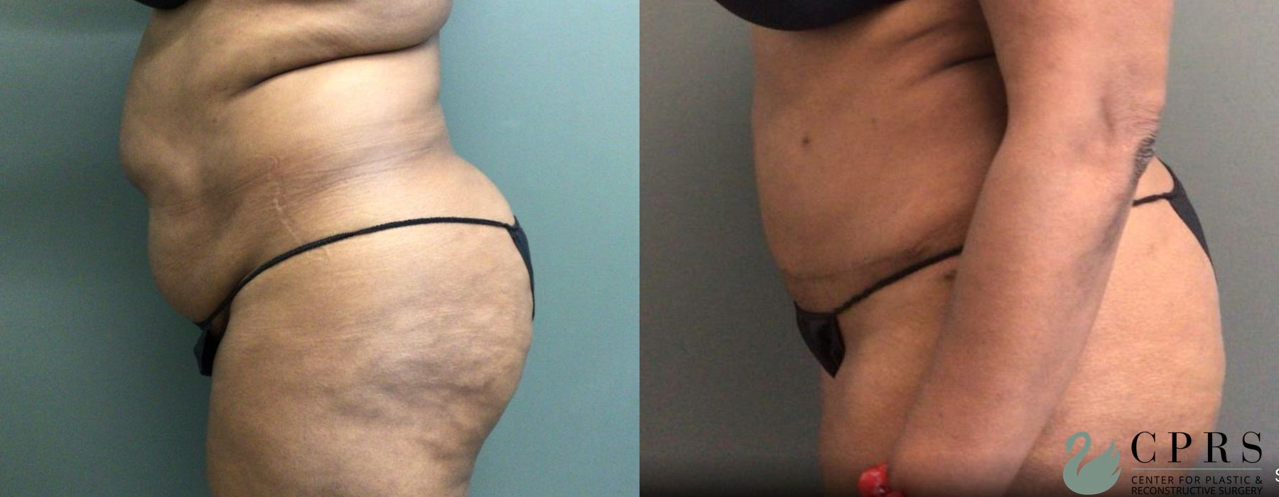 Before and after Abdominoplasty case 19187 - Angle 3