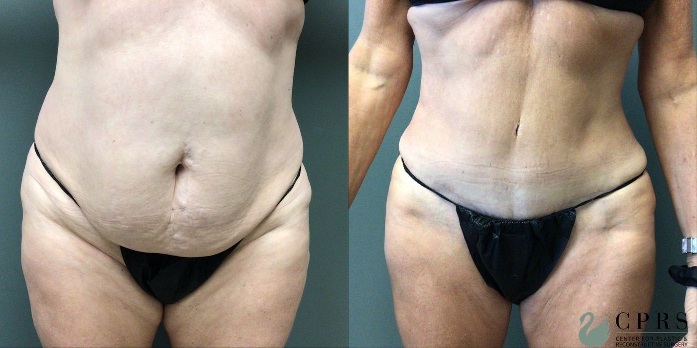 Before and after Abdominoplasty case 21553