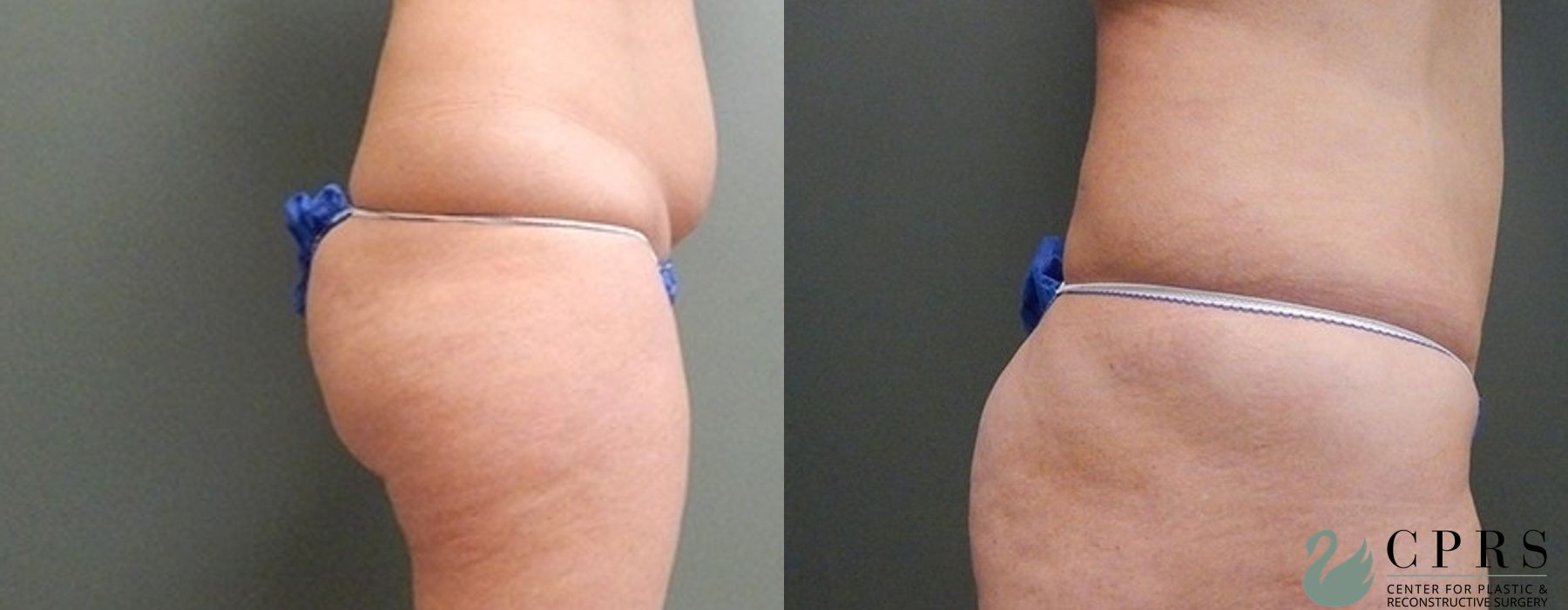 Before and after Abdominoplasty case 19009 - Angle 2