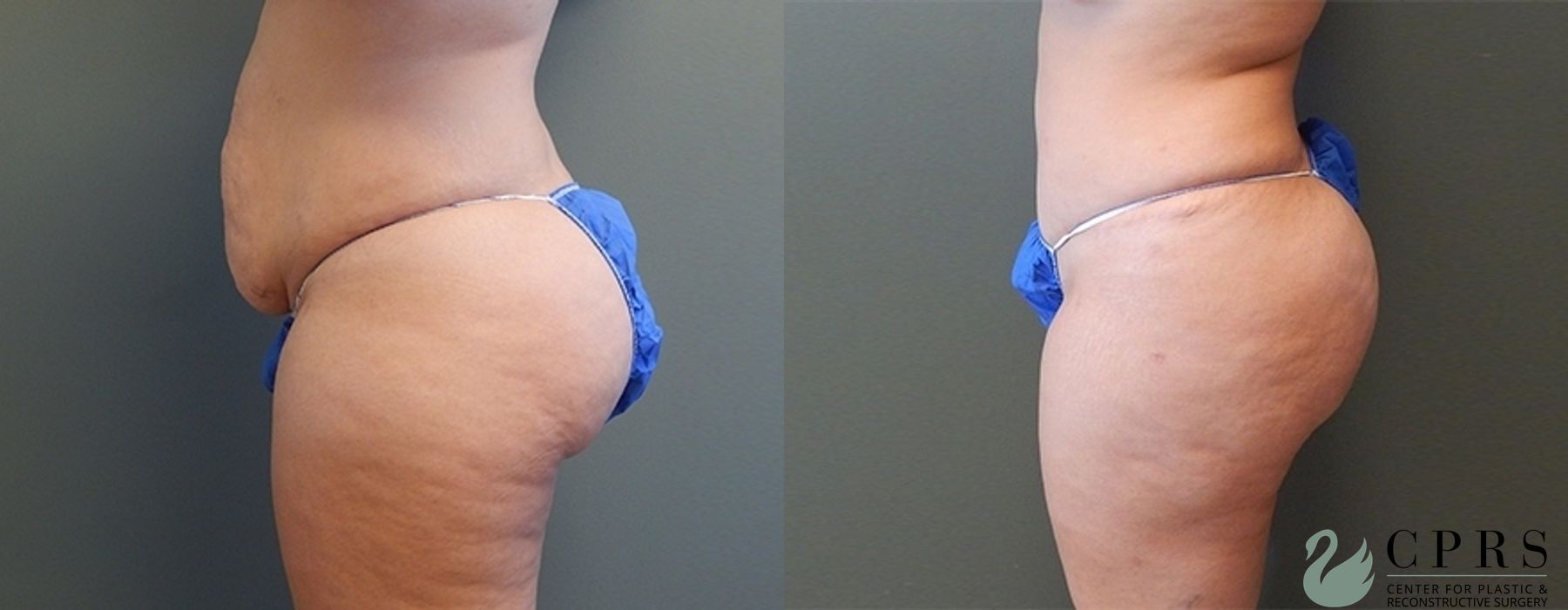 Before and after Abdominoplasty case 18924 - Angle 3