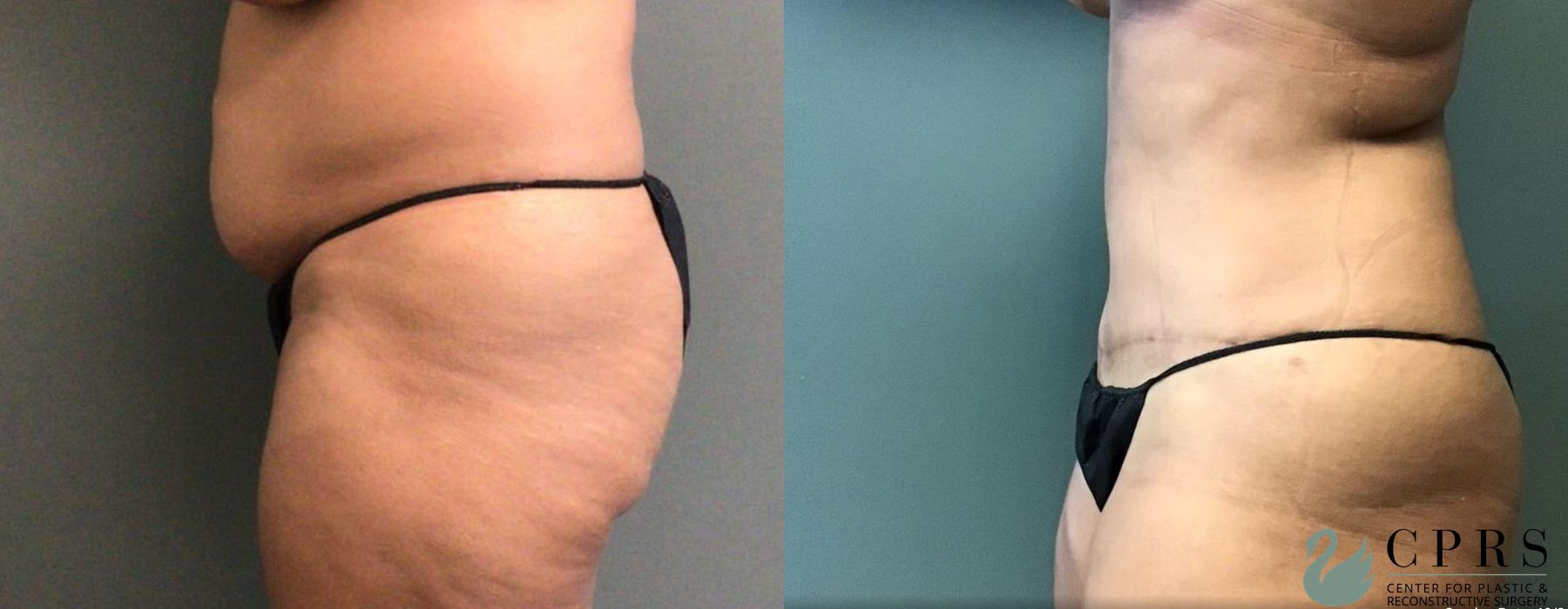 Before and after Abdominoplasty case 19194 - Angle 2