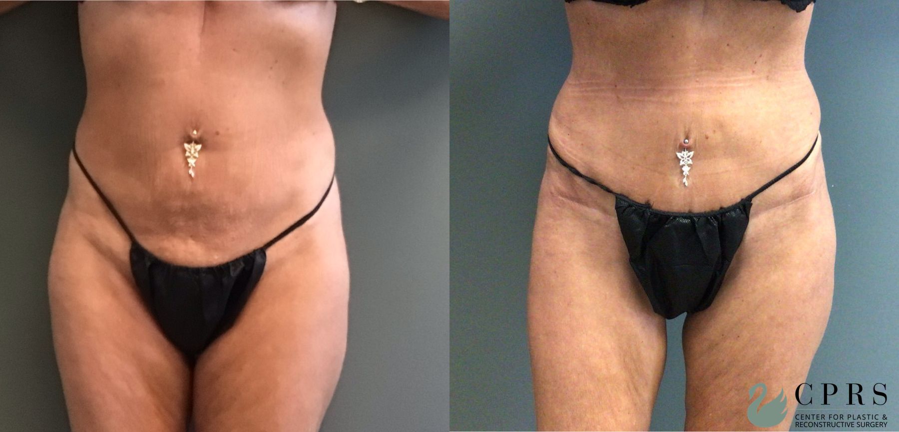 Before and after Abdominoplasty case 49394