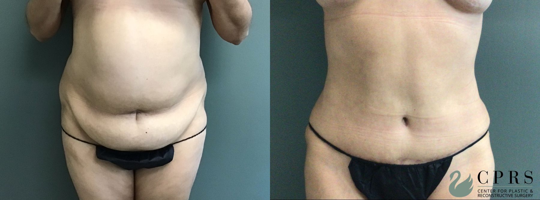 Before and after Abdominoplasty case 43546
