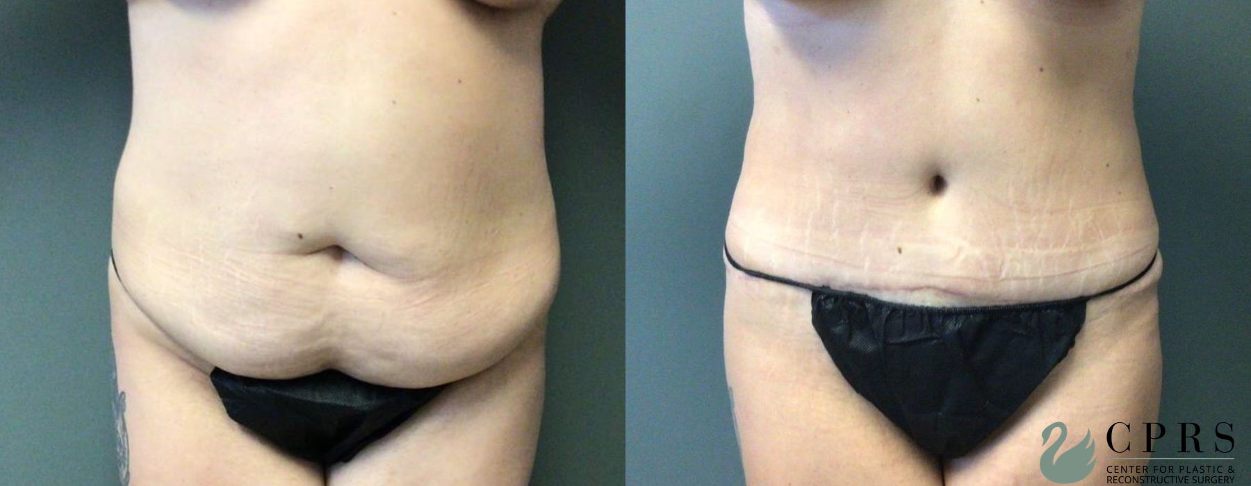 Before and after Abdominoplasty case 19201