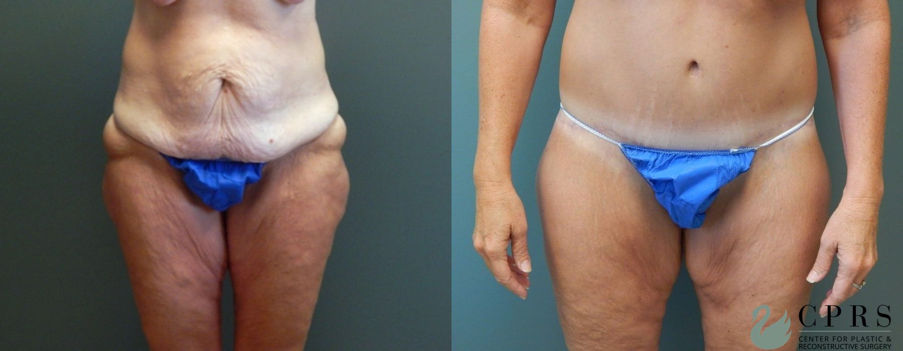Before and after Abdominoplasty case 19000 - Angle 4