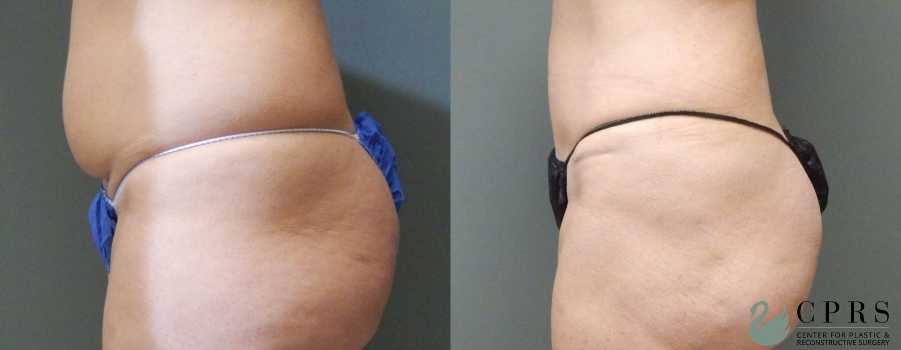 Before and after Abdominoplasty case 19014 - Angle 2