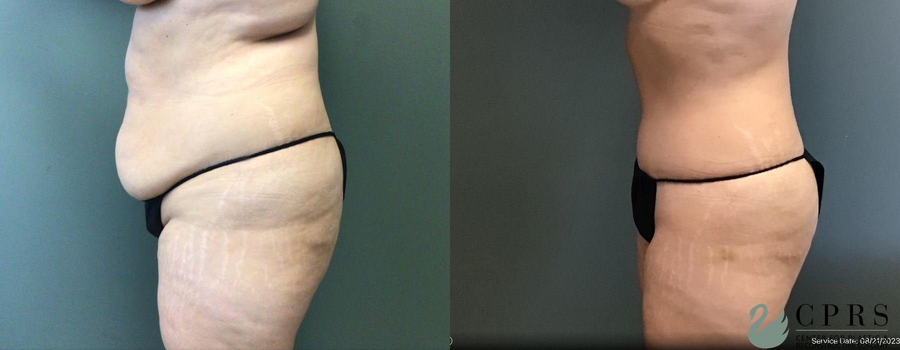 Before and after Abdominoplasty case 19149 - Angle 3
