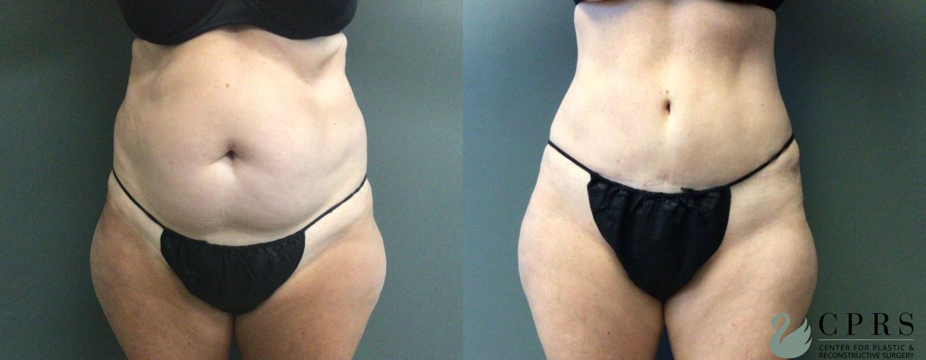 Before and after Abdominoplasty case 19032