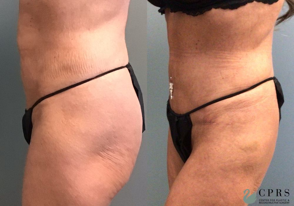 Before and after Abdominoplasty case 36794